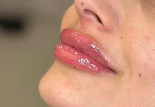 buze acid hialuronic cluj-1