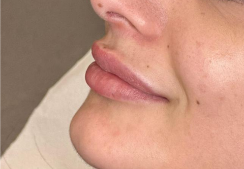 buze acid hialuronic timisoara