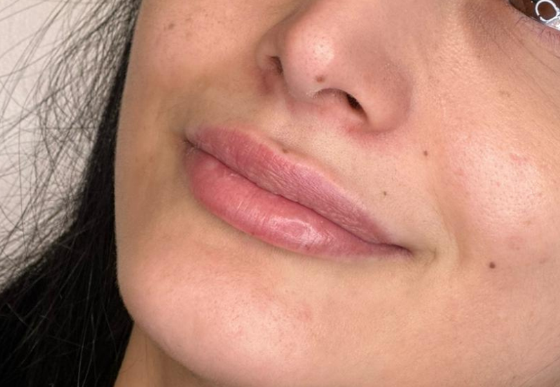 buze acid hialuronic