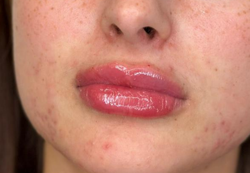 buze uscate si crapate clinica prestige