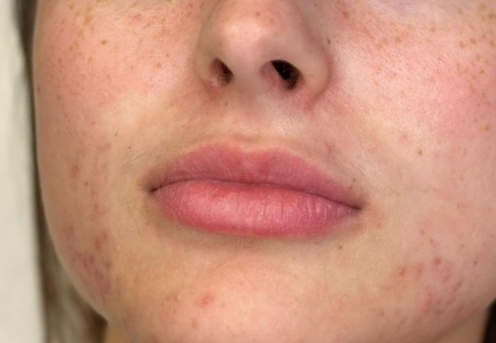 buze uscate si crapate