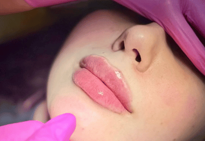 colagen cu acid hialuronic cluj