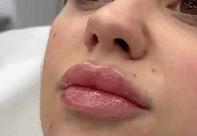 colagen cu acid hialuronic timisoara