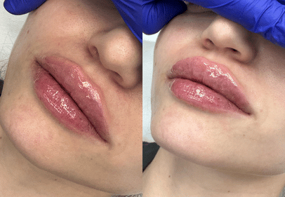 colagen cu acid hialuronic