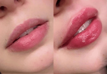 colagen si acid hialuronic bucuresti