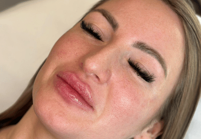 hyaluron pen timisoara