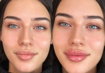 injectare acid hialuronic clinica prestige timisoara