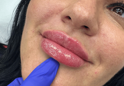 injectare acid hialuronic clinica prestige-Apr-14-2026-07-19-50-6058-PM