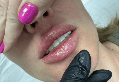 injectare acid hialuronic prestige cluj