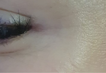 injectare botox ochi clinica prestige bucuresti