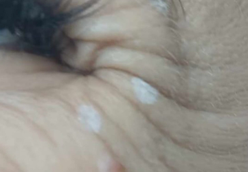 injectare botox ochi clinica prestige