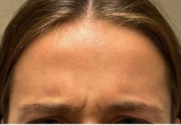 injectare botox riduri intre sprancene clinica prestige bucuresti