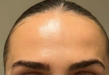 injectare botox riduri intre sprancene clinica prestige cluj