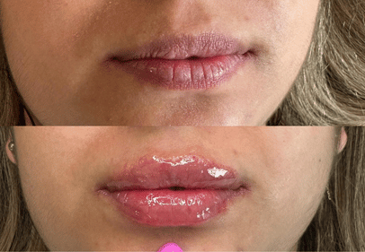 juvederm timisoara