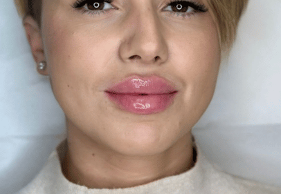 juvederm ultra 3 bucuresti