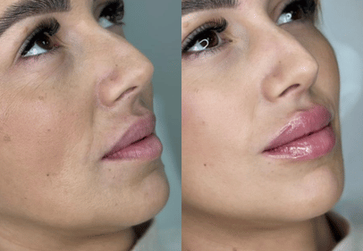 juvederm ultra 3 cluj