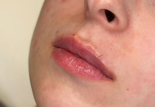 juvederm ultra smile bucuresti