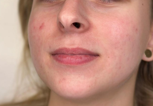 juvederm ultra smile clinica prestige