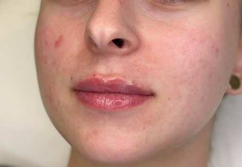 juvederm ultra smile timisoara