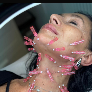 lifting facial cu fire PDO Clinica Prestige Bucuresti (2)