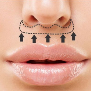 lip lift bucuresti