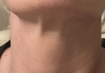 nefertiti neck lift clinica prestige bucuresti