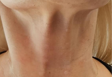 nefertiti neck lift clinica prestige