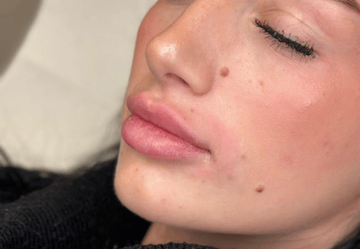 revox acid hialuronic bucuresti