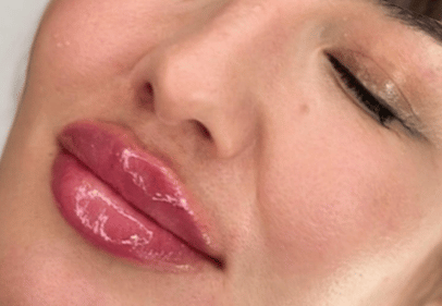 revox acid hialuronic