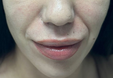 santuri nazogeniene clinica prestige bucuresti