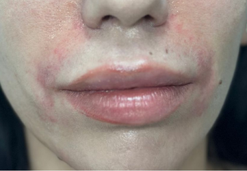 santuri nazolabiale clinica prestige bucuresti